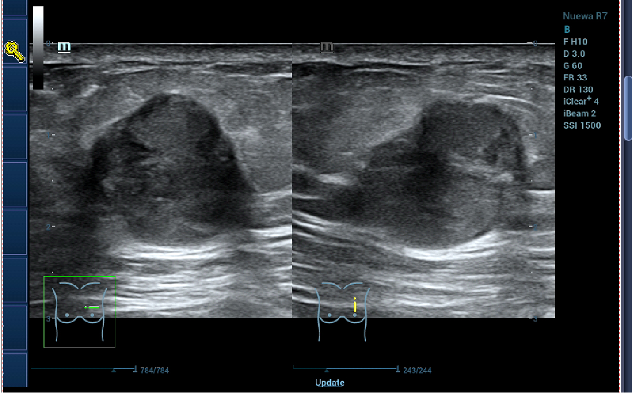 乳腺彩超.png