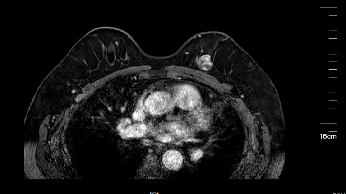 乳腺MRI.png