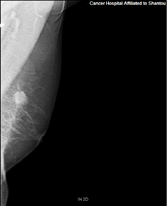 乳腺钼靶.png